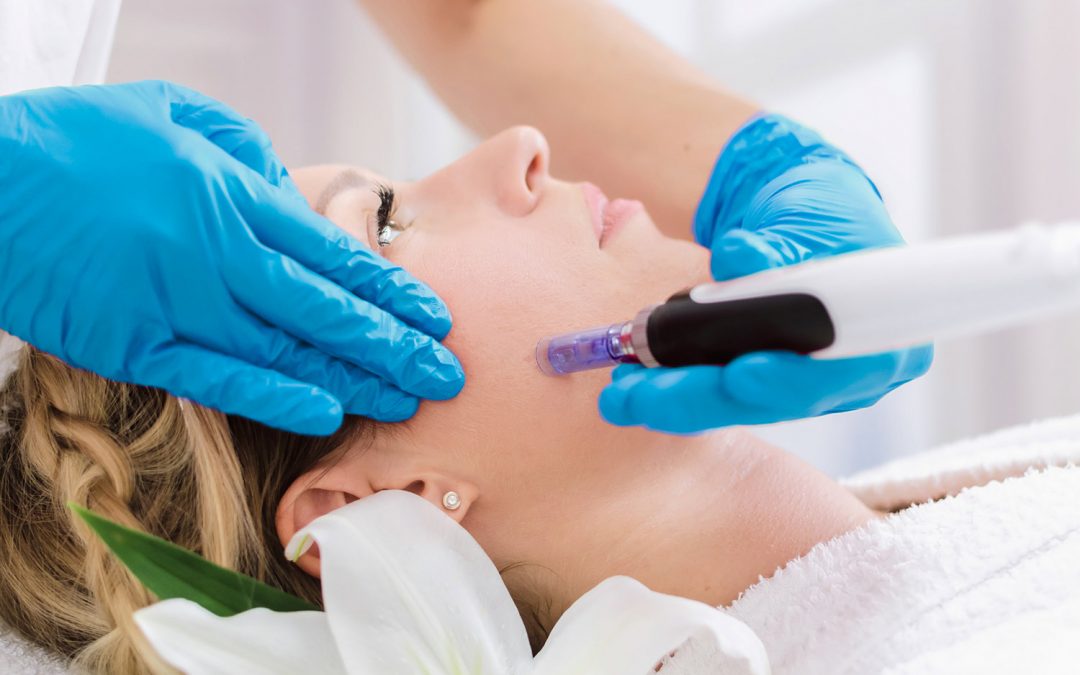 Microneedling